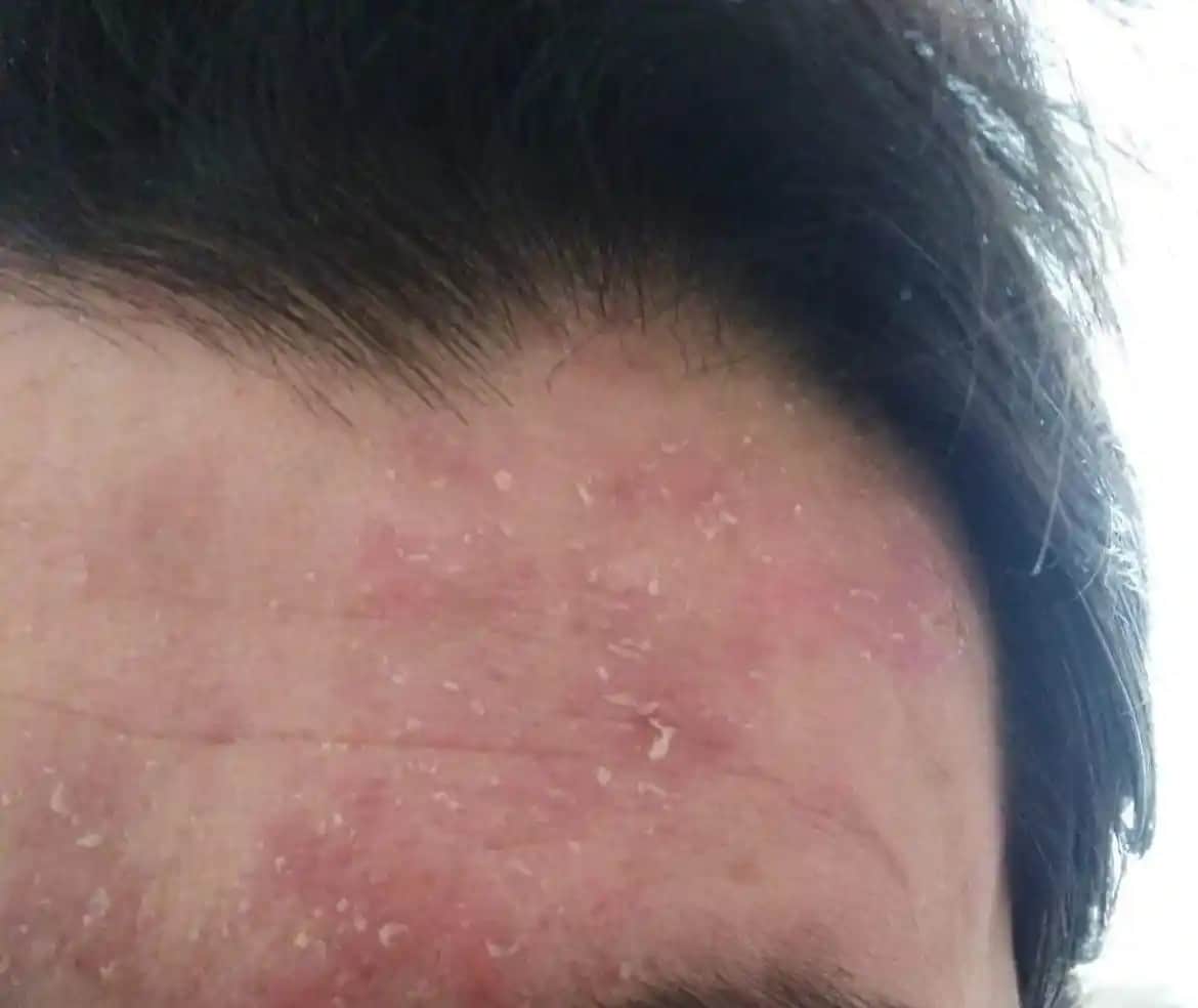 Seboreik Egzema ve Kozmetik Yaklaşımlar: Belirtiler, Nedenler ve Bakım İpuçları