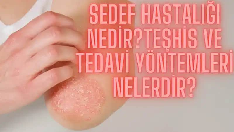 Sedef Hastalığı İçin Uygun Diyet Yaklaşımları ve Beslenme Tavsiyeleri