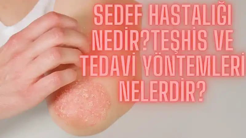 Sedef Hastalığı İçin Uygun Diyet Yaklaşımları ve Beslenme Tavsiyeleri