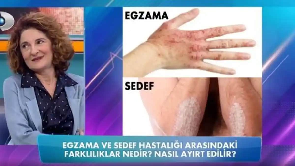 Sedef Hastalığı ve Egzama Arasındaki Farklar ile Doğru Cilt Bakım Yöntemleri