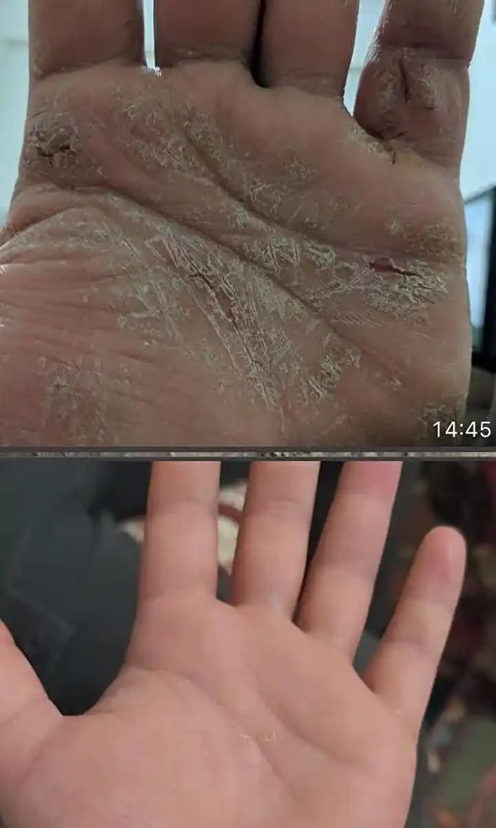 Sedef Hastalığına Karşı Güvenilir ve Etkili Cilt Bakım Yöntemleri