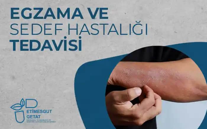 Sedef ve Egzama Arasındaki Farklar: Cilt Sağlığını Anlamak ve Koruma Yolları