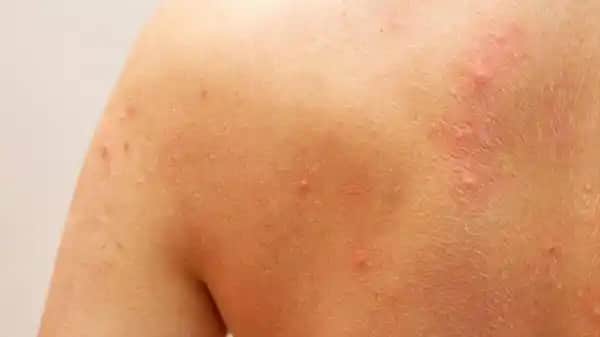 Sırt Ağrılı Sivilceler ve Kozmetik Bakımda Güncel Çözüm Yaklaşımları