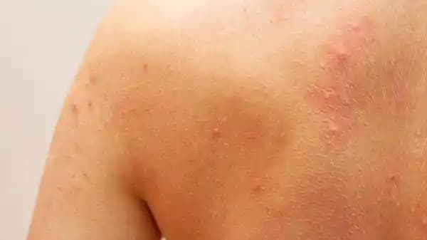 Sırt Ağrılı Sivilceler ve Kozmetik Bakımda Güncel Çözüm Yaklaşımları