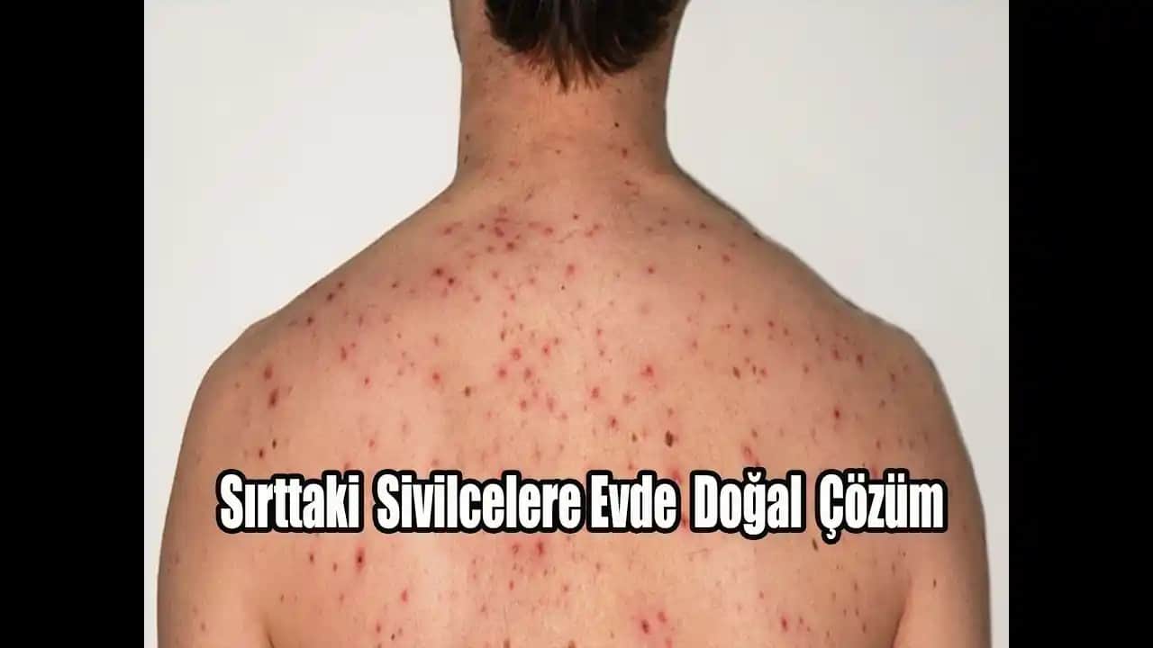 Sırt Sivilcelerine Karşı Etkili Yöntemler ve Günlük Bakım İpuçları