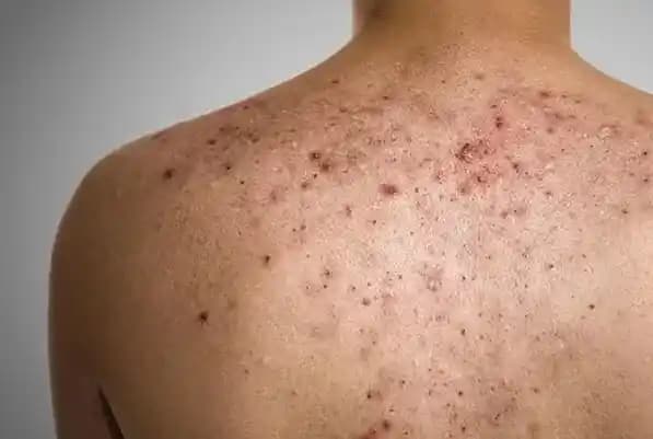 Sırt Sivilcesi Nasıl Geçer ve Etkili Çözüm Yöntemleri Nelerdir