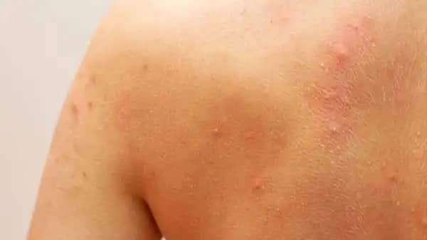 Sırt Sivilcesi Nedenleri ve Etkili Önleme Yöntemleri Hakkında Bilgiler