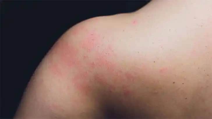 Sırtta Kızarıklık Nedenleri ve Tedavi Yöntemleri Hakkında Detaylı Bilgi