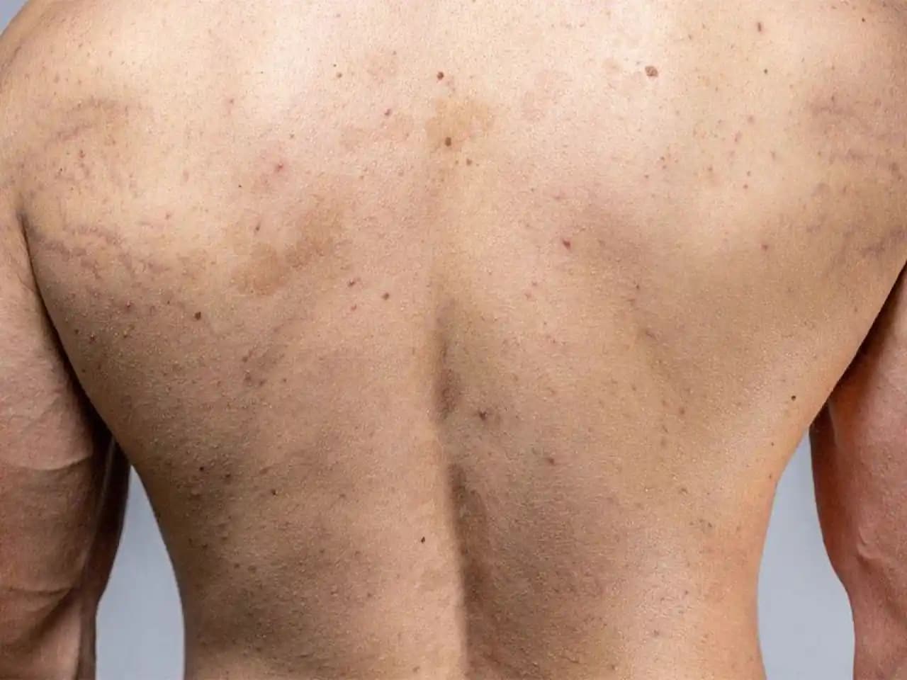 Sırtta Yara Nedenleri ve Cilt Sağlığını Koruma Yöntemleri Hakkında Kapsamlı Bilgi