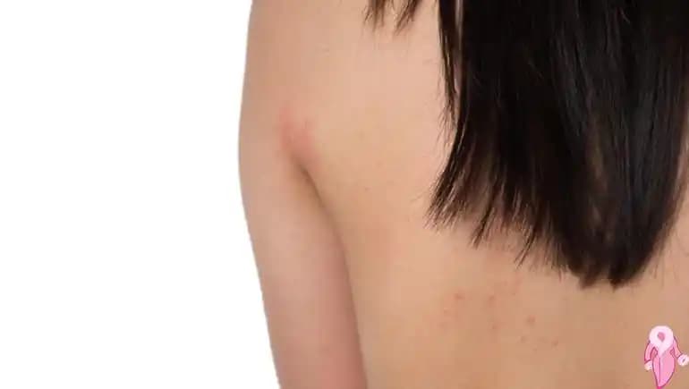 Sırttaki Lekelerin Nedenleri Türleri ve Etkili Çözüm Yolları