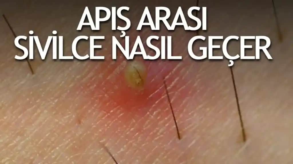 Sivilce Apsesi Nedir ve Cilt Sağlığını Koruma Yöntemleri
