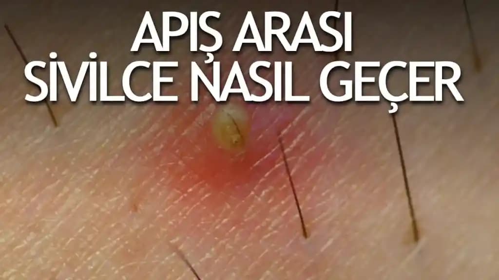 Sivilce Apsesi Nedir ve Cilt Sağlığını Koruma Yöntemleri
