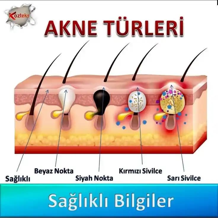 Sivilce Çeşitleri ve Cilt Sağlığında Rolü Hakkında Kapsamlı Bilgi