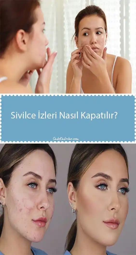 Sivilce İzi Kapama Yöntemleri ve Doğal Çözümlerle Pürüzsüz Cilde Ulaşma