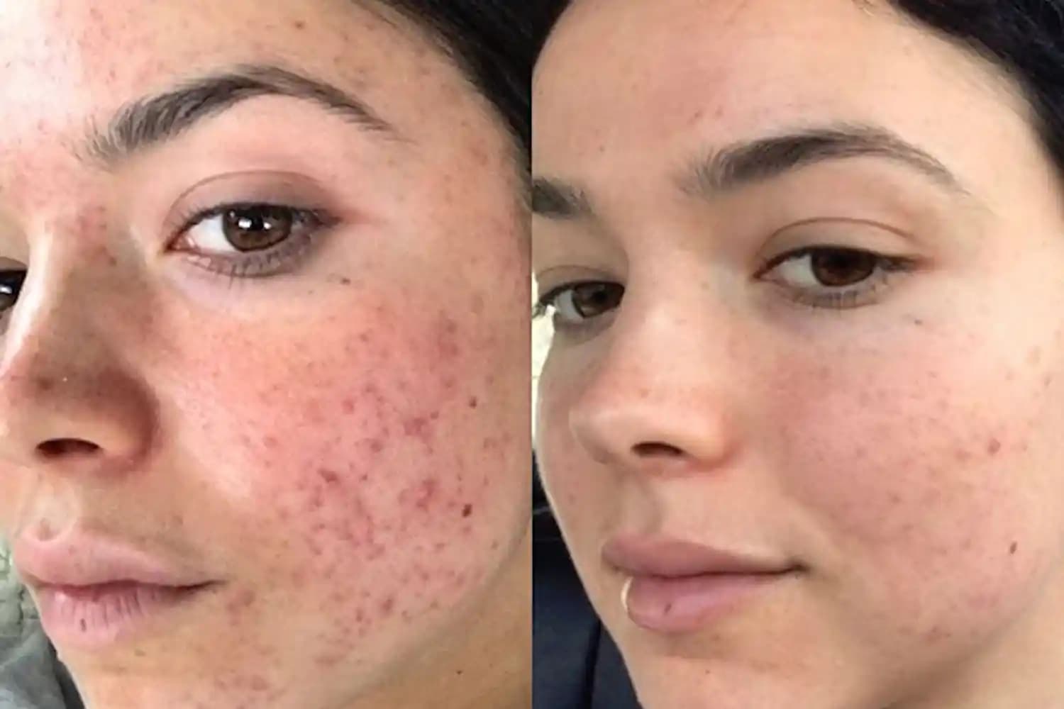 Sivilce İzi Lazer Tedavisi ile Cilt Yenileme ve Estetik Çözümler