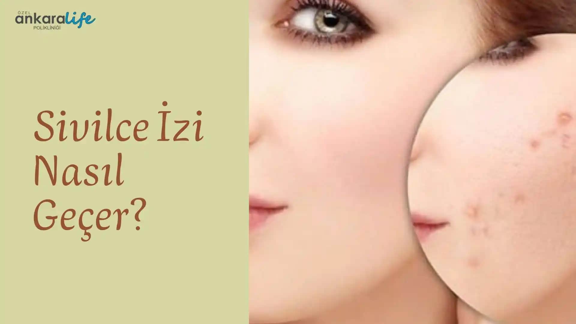 Sivilce İzlerinin Geçmesi İçin Etkili Yöntemler ve Cilt Bakım Tavsiyeleri