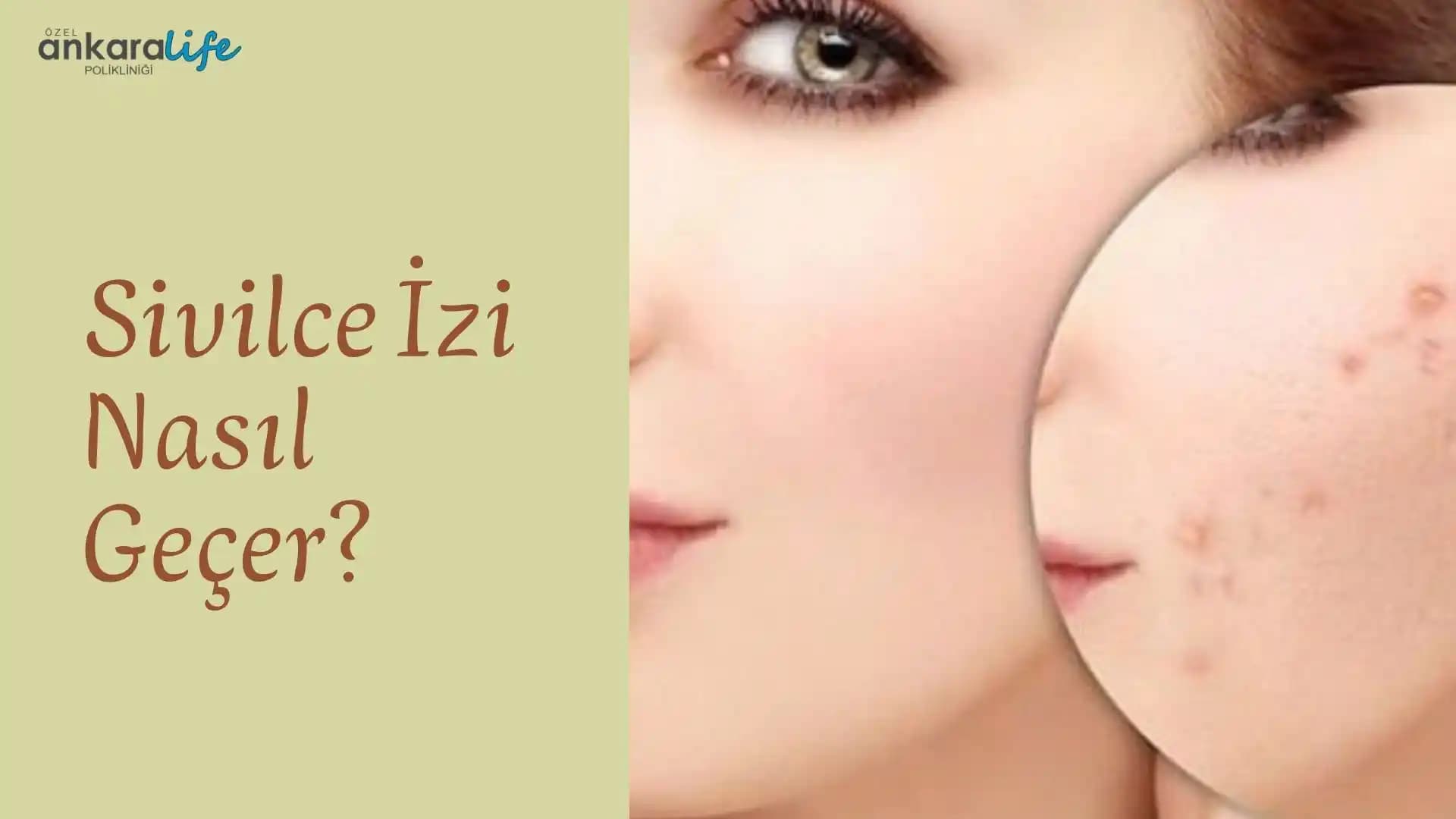 Sivilce İzlerinin Geçmesi İçin Etkili Yöntemler ve Cilt Bakım Tavsiyeleri