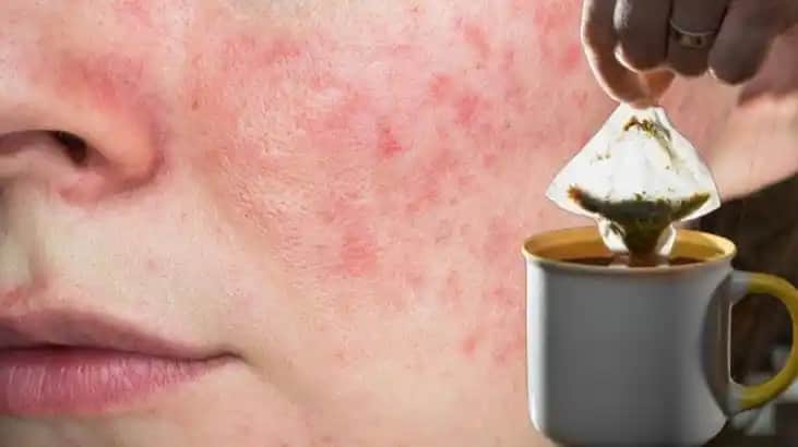 Sivilce Kızarıklığını Azaltan Doğal ve Kozmetik Çözümlerle Cilt Sağlığını Koruma