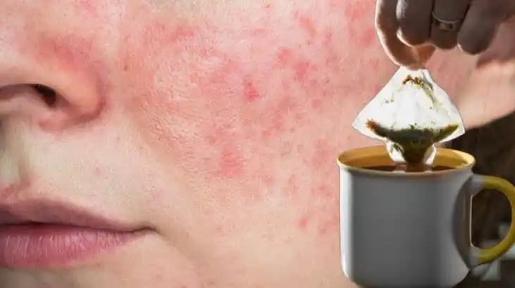 Sivilce Kızarıklığını Azaltan Doğal ve Kozmetik Çözümlerle Cilt Sağlığını Koruma