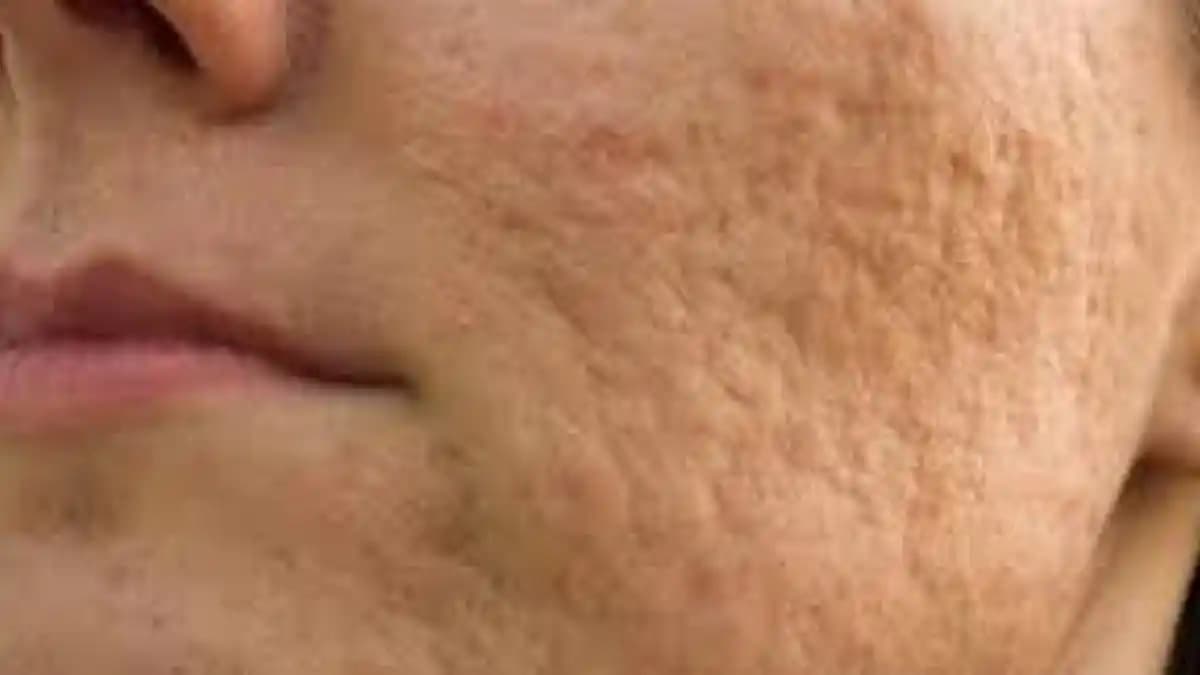 Sivilce Lekeleri Nasıl Geçer Cilt Sağlığını Koruyan Etkili Yöntemler