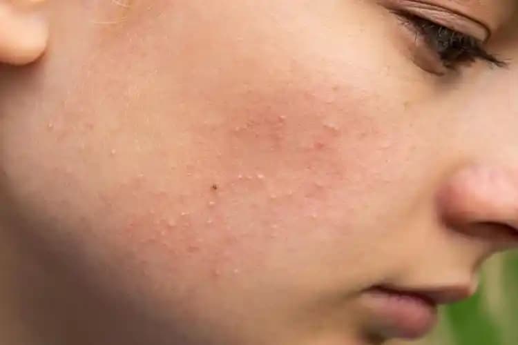 Sivilce Lekelerine İyi Gelen Asitler ve Doğru Kullanım Yöntemleri