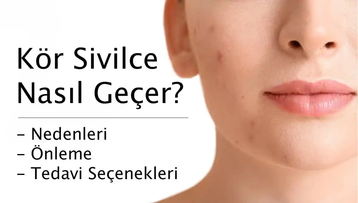 Sivilce Nasıl Geçer ve Cilt Sağlığını Korumanın Etkili Yolları