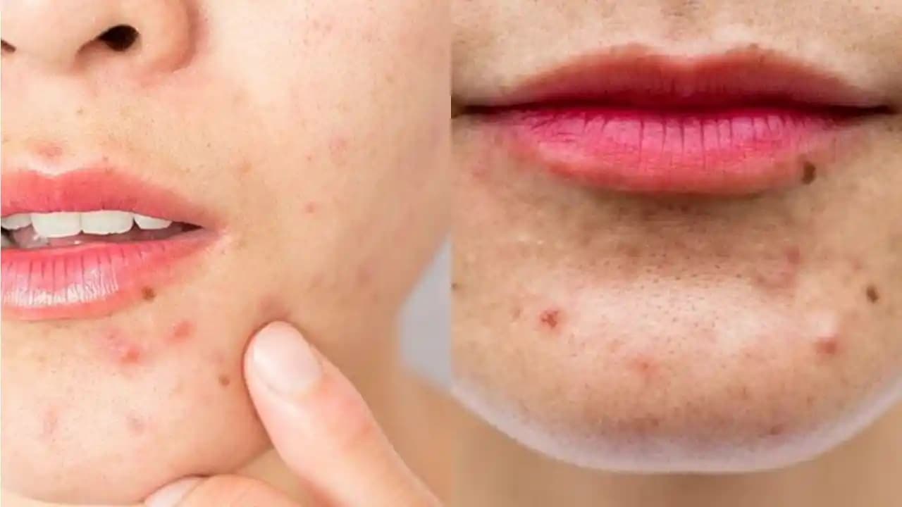 Sivilce Nedenleri ve Cilt Sağlığı Üzerindeki Etkileri Analizi