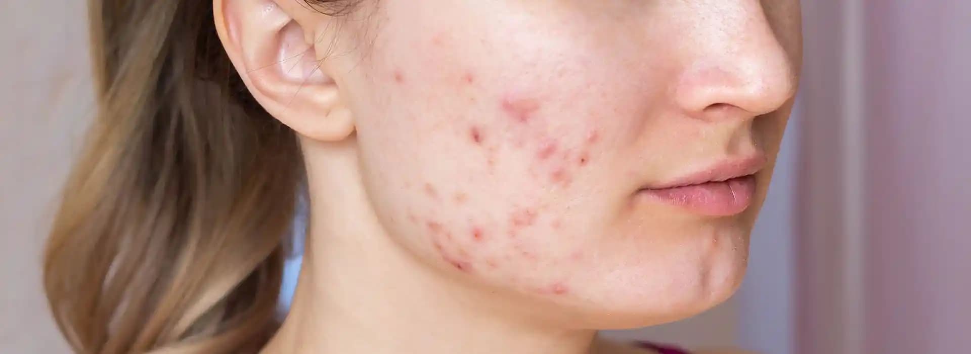 Sivilce Nedir? Cilt Sağlığını Korumanın Yolları ve Doğru Kozmetik Seçenekleri