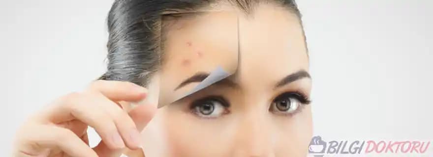 Sivilce Oluşumunu Engellemek İçin Bilimsel ve Pratik Yöntemler