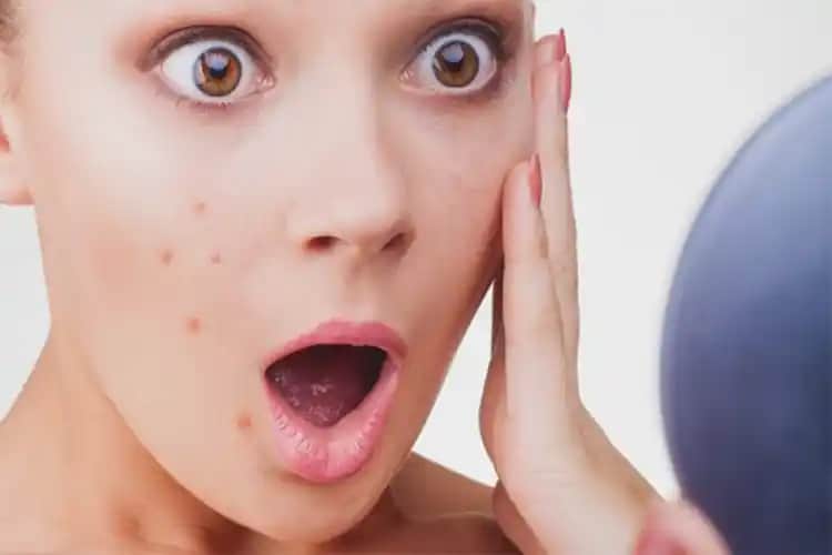 Sivilce Sıkma Sonrası Kızarıklık Nasıl Geçer ve Cilt Bakımında Dikkat Edilmesi Gerekenler