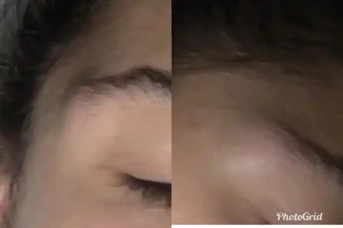 Sivilce Şişmesinin Nedenleri ve Etkili Cilt Bakım Yöntemleri