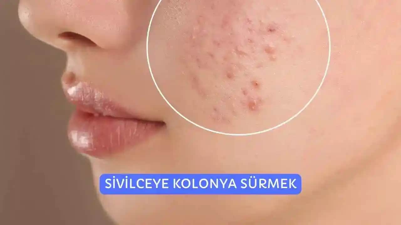 Sivilce Tedavisinde Aseton Kullanımının Tehlikeleri ve Doğru Cilt Bakımı İpuçları