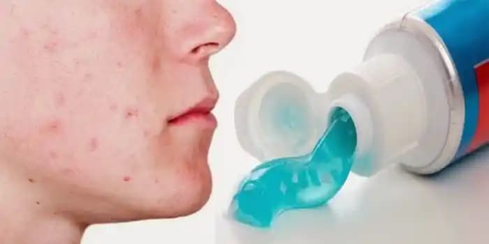 Sivilce Tedavisinde Diş Macunu Kullanımı: Bilimsel Gerçekler ve Güvenli Alternatifler