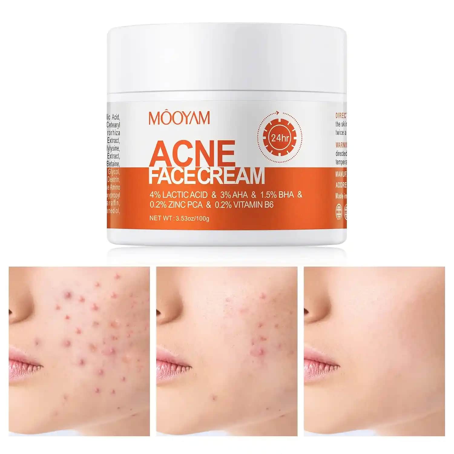 Sivilce Tedavisinde Etkili Çözümler ve Doğru Ürün Seçimi Rehberi