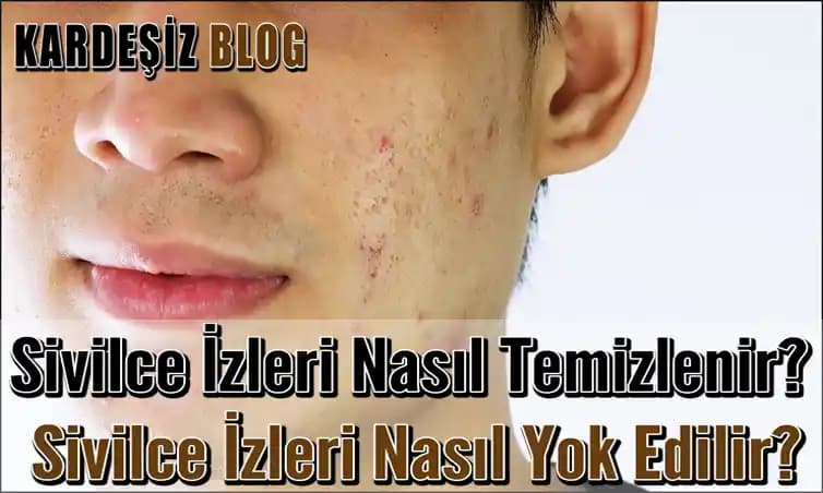 Sivilce Temizleme Yöntemleri ve Cilt Sağlığı İçin Bilimsel İpuçları