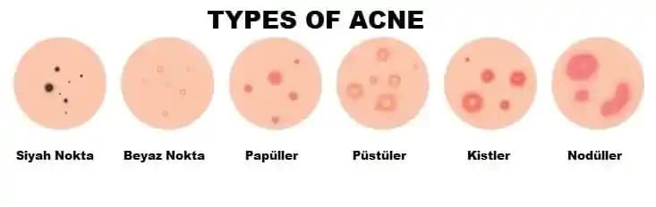 Sivilce Tipleri ve Cilt Sağlığı Üzerindeki Etkileri Hakkında Kapsamlı Bilgi