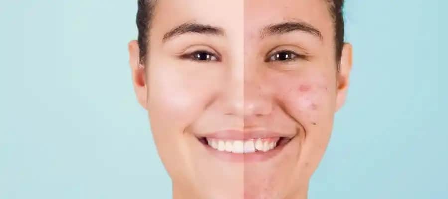 Sivilce ve Akne Arasındaki Farklar: Sağlıklı Bir Cilt İçin Bilmeniz Gerekenler