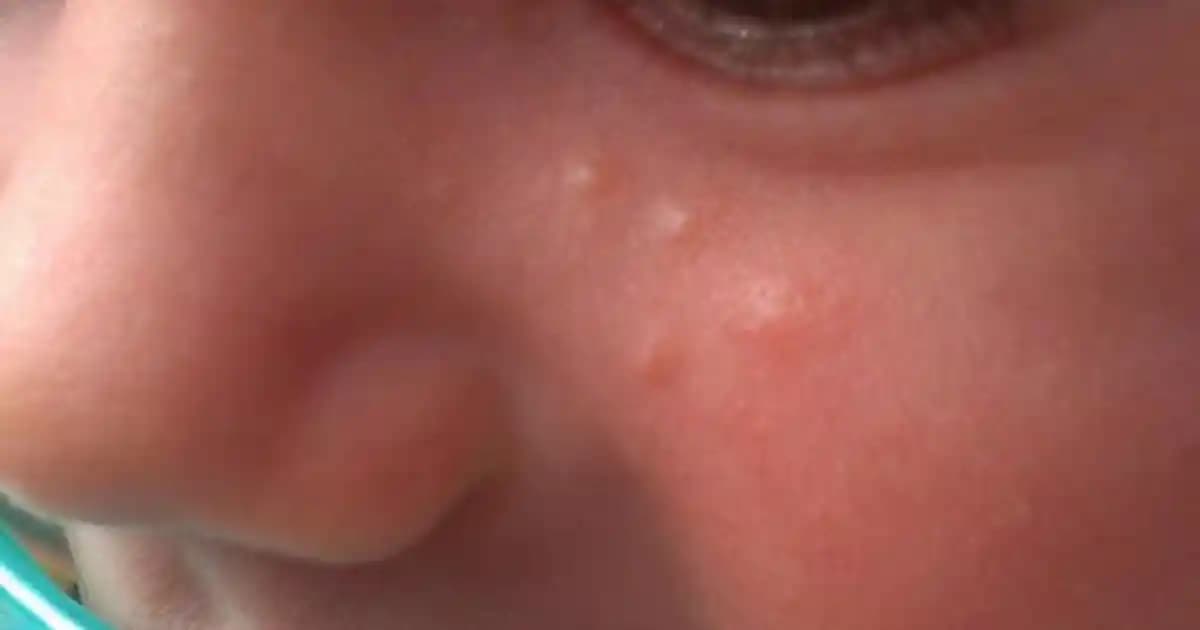 Sivilce ve Komedonların Oluşumu, Önlenmesi ve Etkili Tedavi Yöntemleri