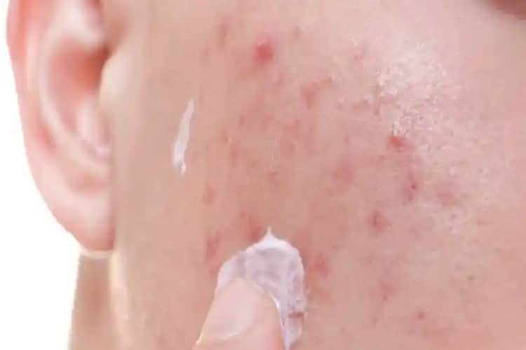 Sivilce Yaralarına Ne Sürülür Cilt Sağlığını Koruyan Etkili Yöntemler