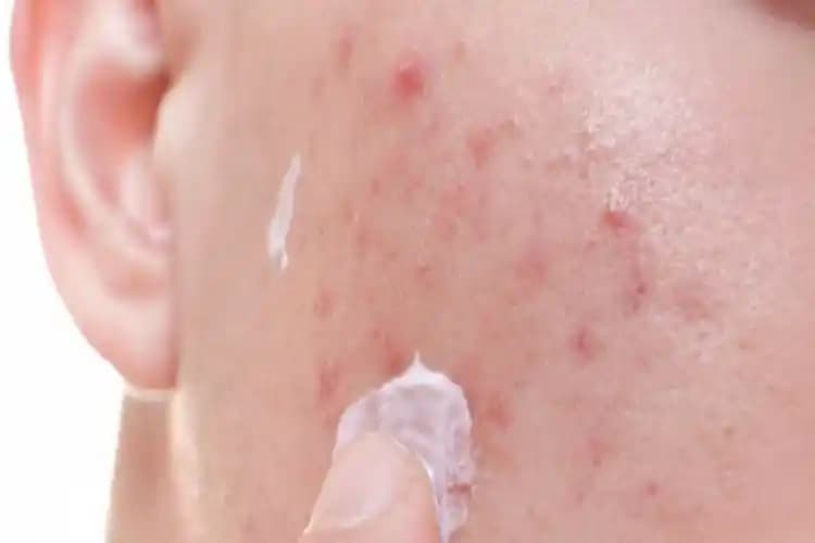 Sivilce Yaralarına Ne Sürülür Cilt Sağlığını Koruyan Etkili Yöntemler