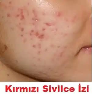 Sivilceden Kalan İzler Nasıl Geçer Cilt Yenileme ve Tedavi Yöntemleri