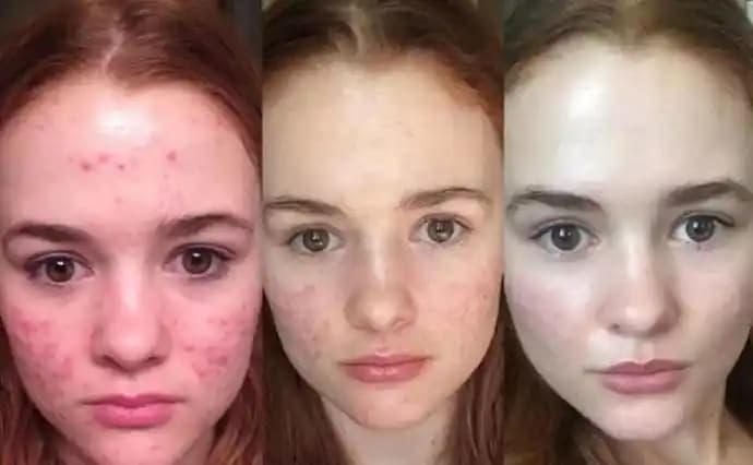 Sivilceler Ne Zaman Biter ve Cilt Sağlığı İçin Öneriler