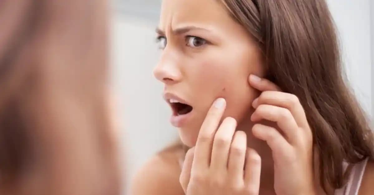 Sivilceleri Yok Etmek İçin Bilimsel Temelli Etkili Yöntemler ve İpuçları