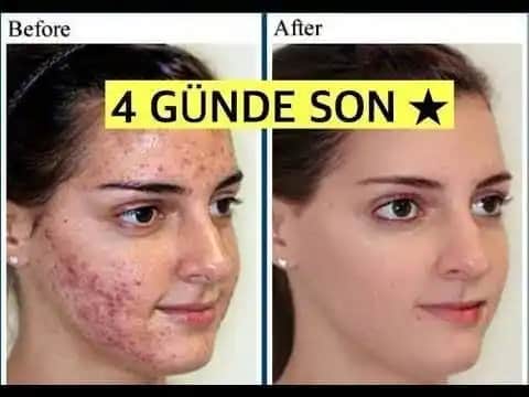 Sivilcelerin Artış Sebepleri ve Cilt Sağlığını Koruma Yöntemleri