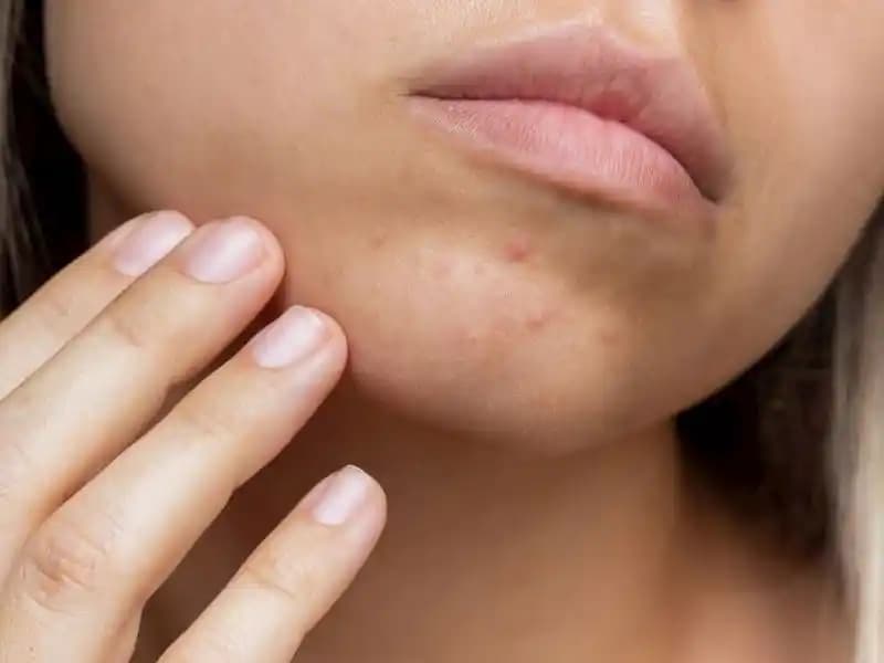 Sivilcelerin Hormonal Olduğunu Nasıl Anlarız ve Doğru Tedavi Yöntemleri