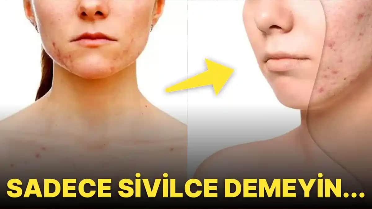 Sivilcelerin Nedenleri ve Cilt Sağlığını Koruma Yöntemleri Rehberi