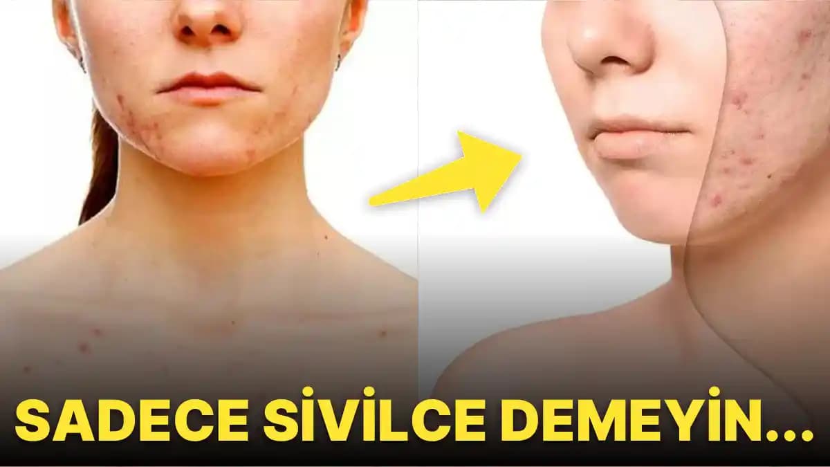 Sivilcelerin Nedenleri ve Cilt Sağlığını Koruma Yöntemleri Rehberi