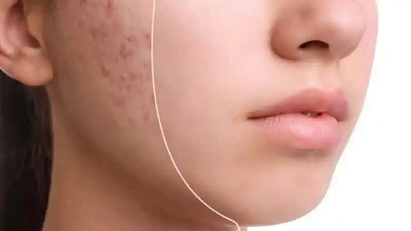 Sivilcenin Geçme Süresi ve Doğru Bakım Yöntemleri Hakkında Bilmeniz Gerekenler