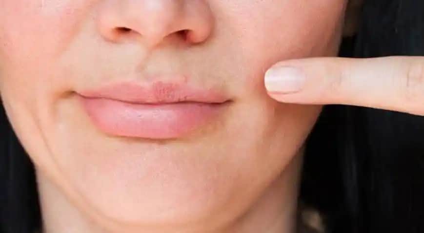 Sivilceye Karşı Diş Macunu Kullanımı: Gerçekler ve Doğru Cilt Bakımı Yöntemleri