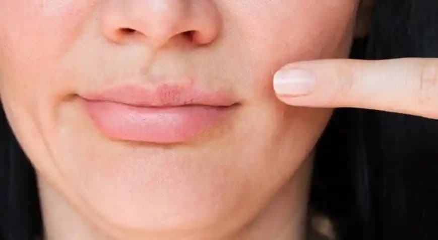 Sivilceye Karşı Diş Macunu Kullanımı: Gerçekler ve Doğru Cilt Bakımı Yöntemleri